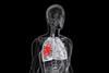 lung disease asbestos asbestosis mesothelioma